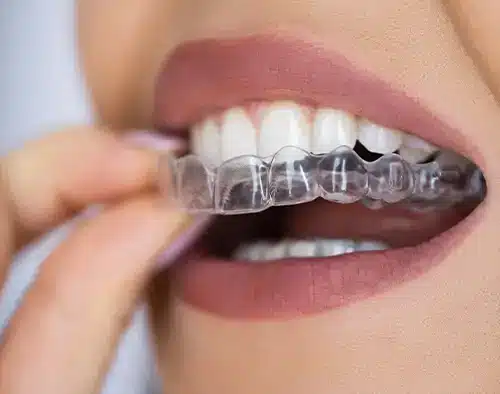 clear aligners being applied to teeth closeup