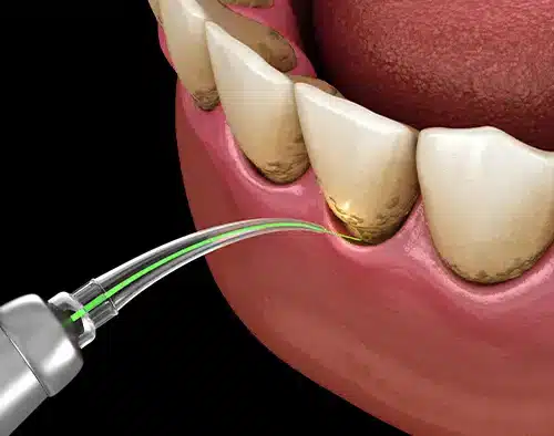 graphic of gum disease