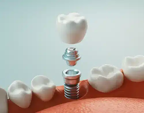 graphic of implants being inserted into the mouth